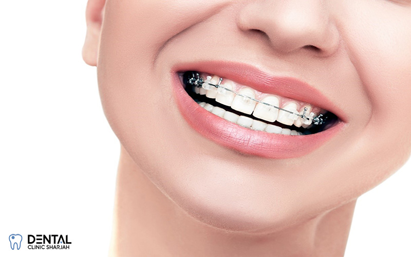 Straighten Your Smile with Scandinavian Dental Clinic