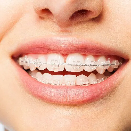 ceramic-braces-in-dubai ceramic-braces-in-dubai