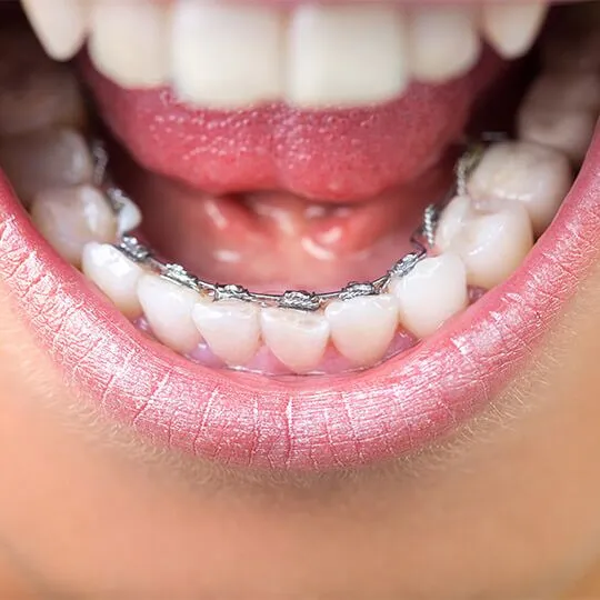 lingual-braces-in-dubai lingual-braces-in-dubai
