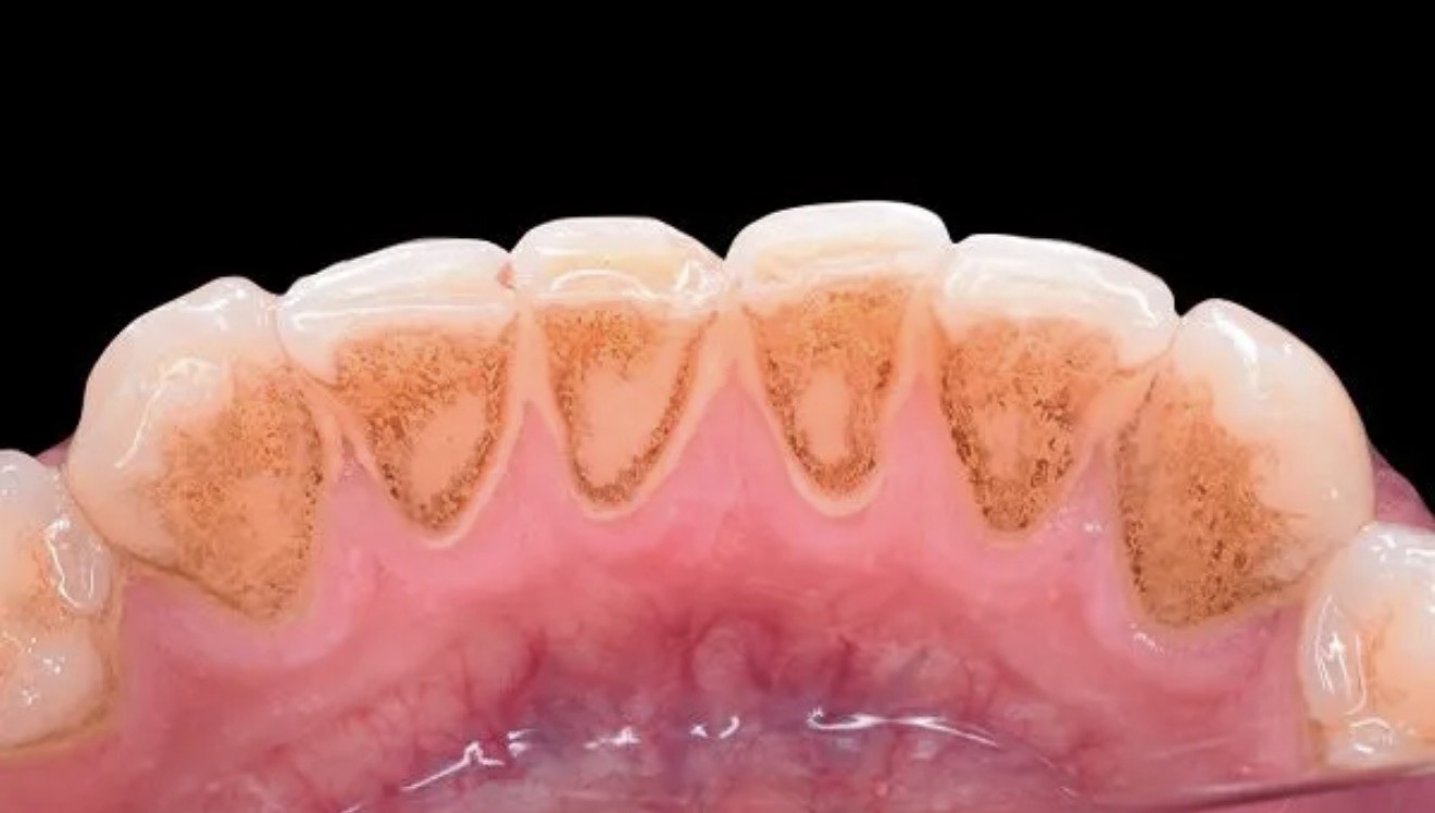 tooth cleaning