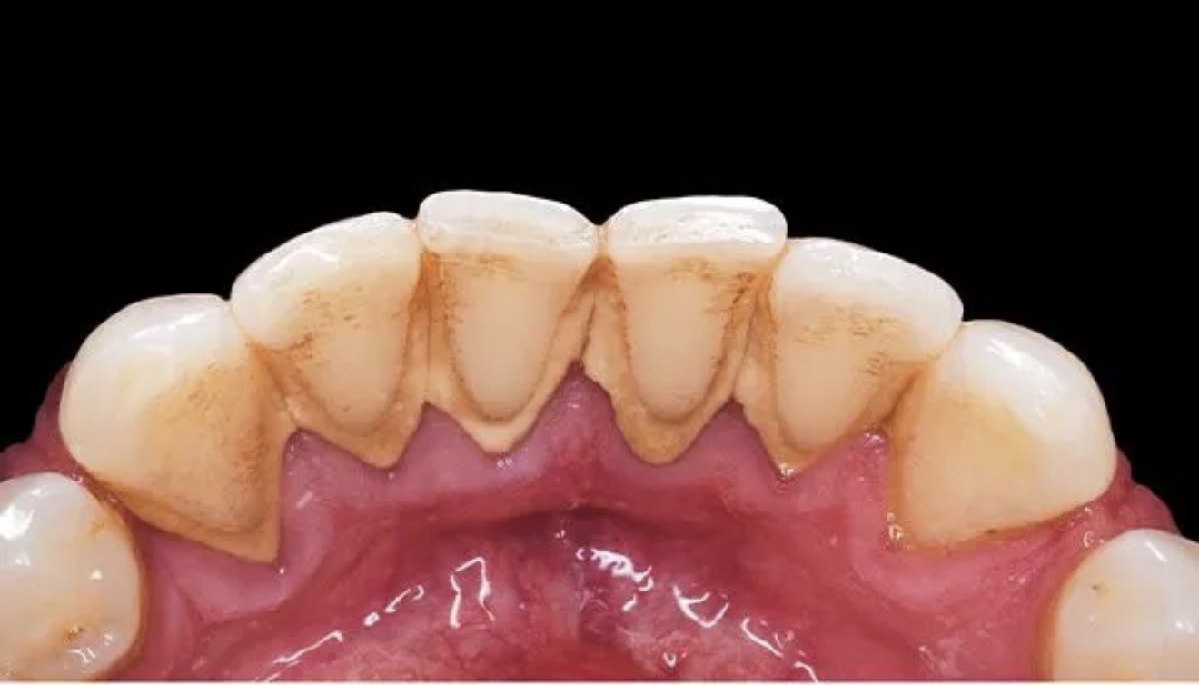 teeth cleaning in dubai