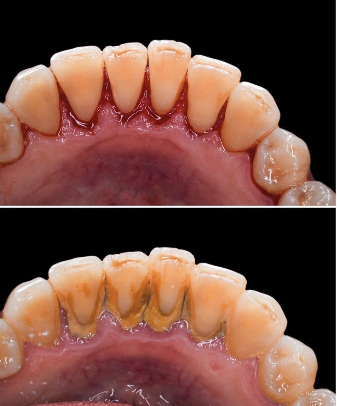 teeth cleaning