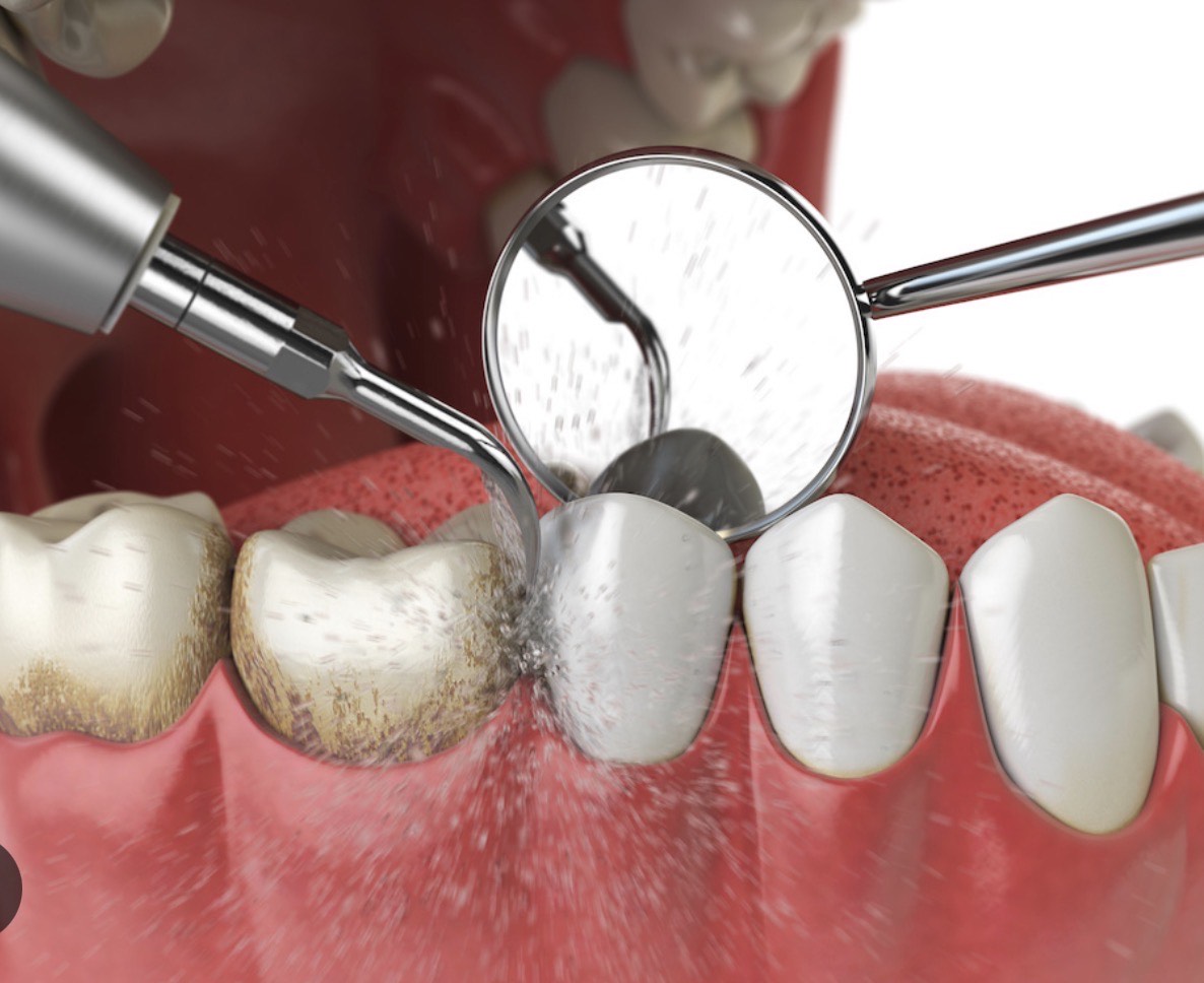 teeth cleaning