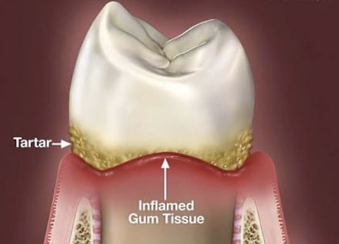 gum disease