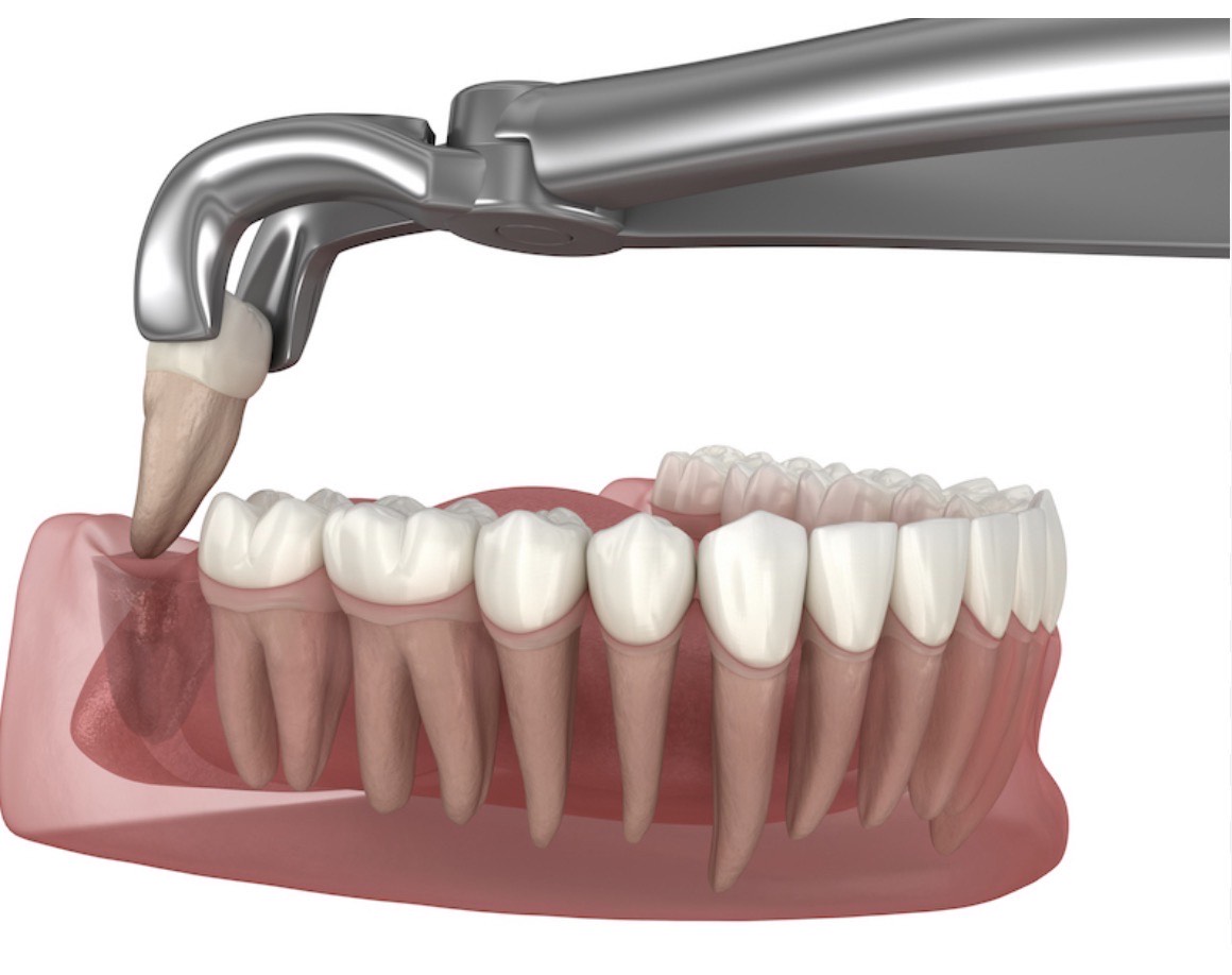 wisdom tooth extraction