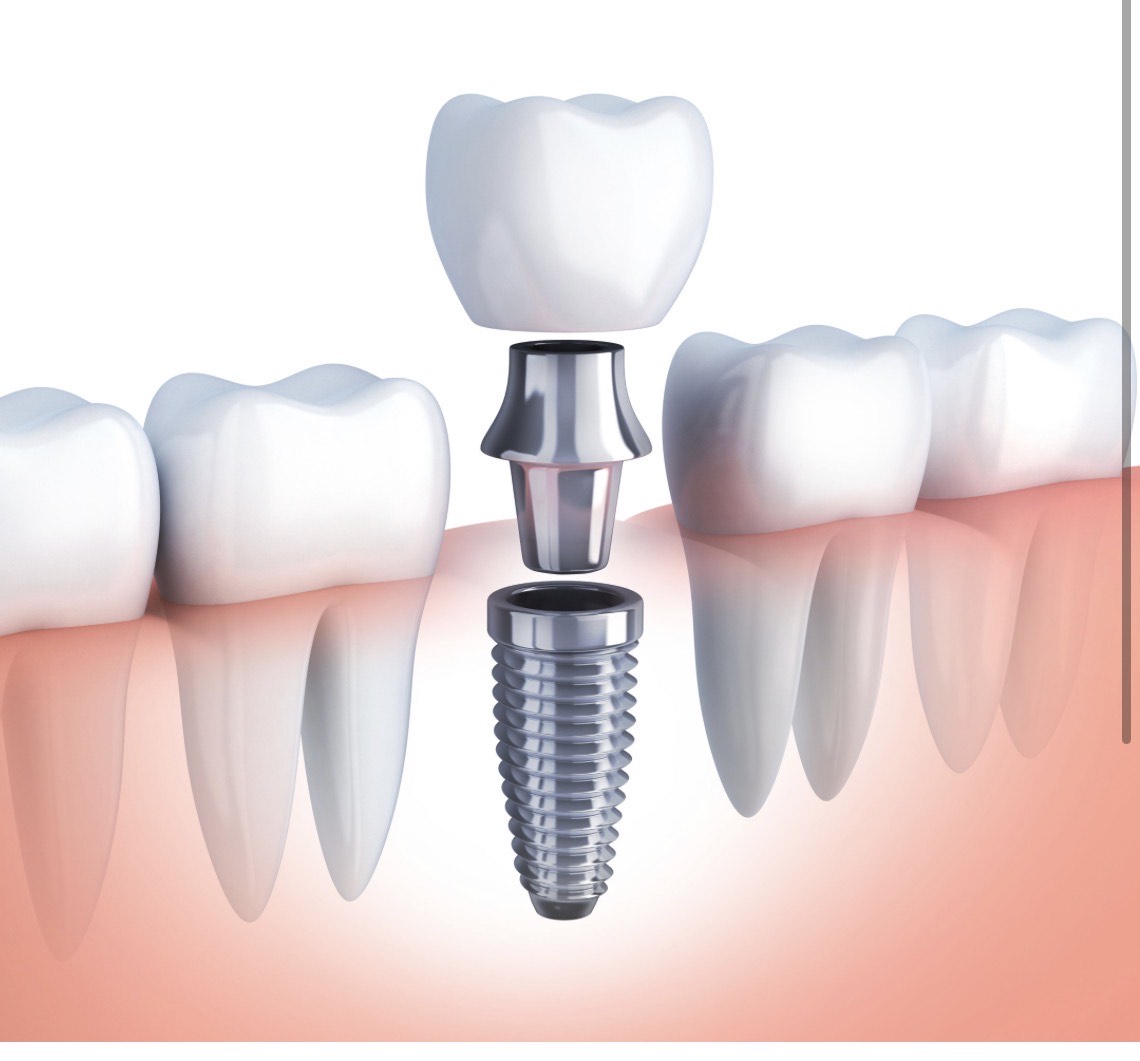 implant