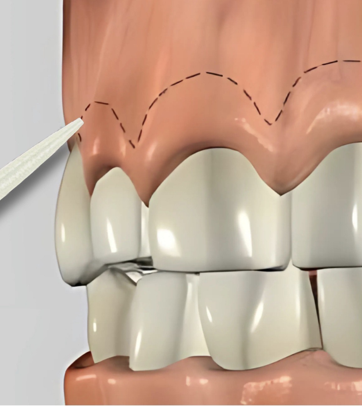 crown lengthening
