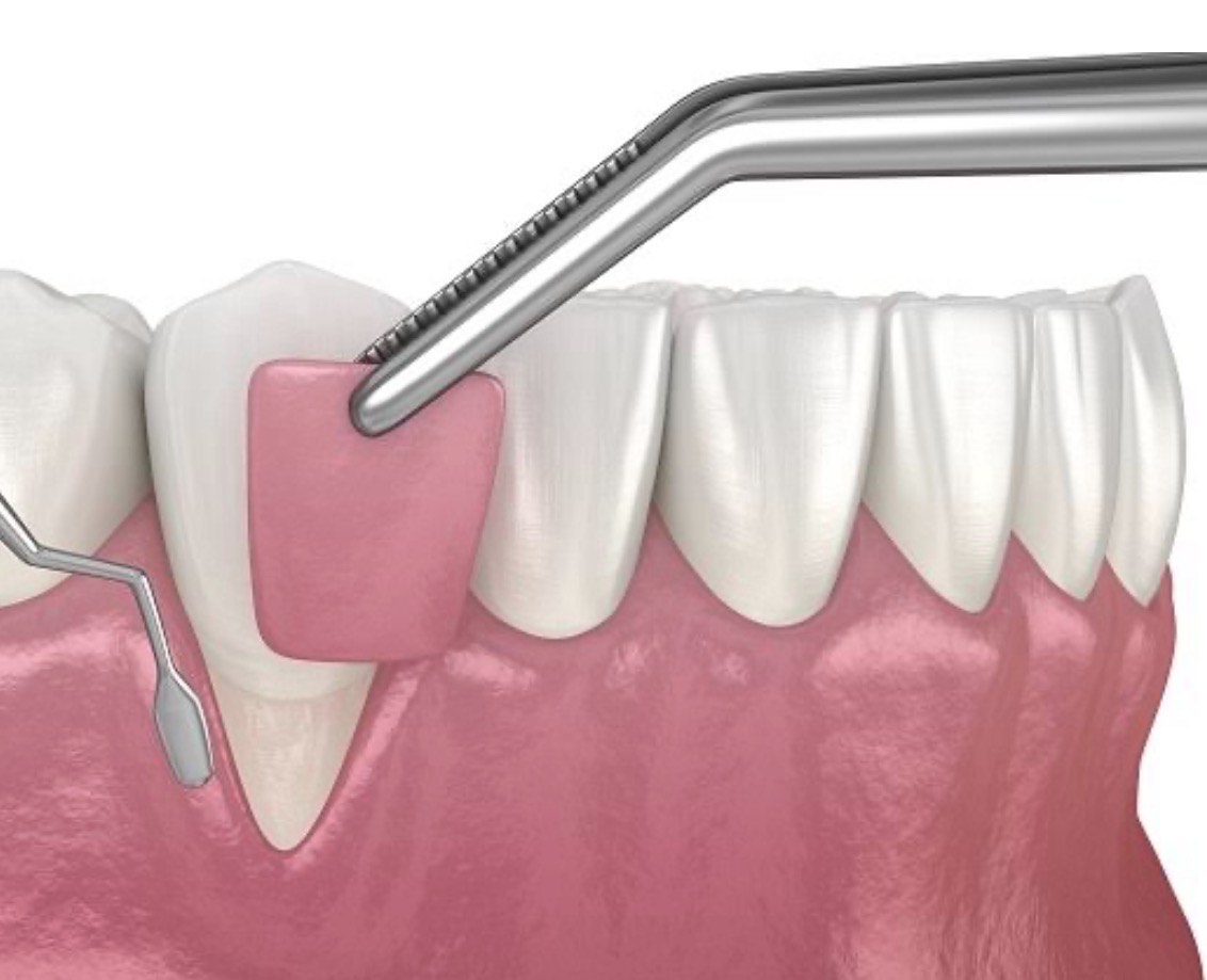 gum graft