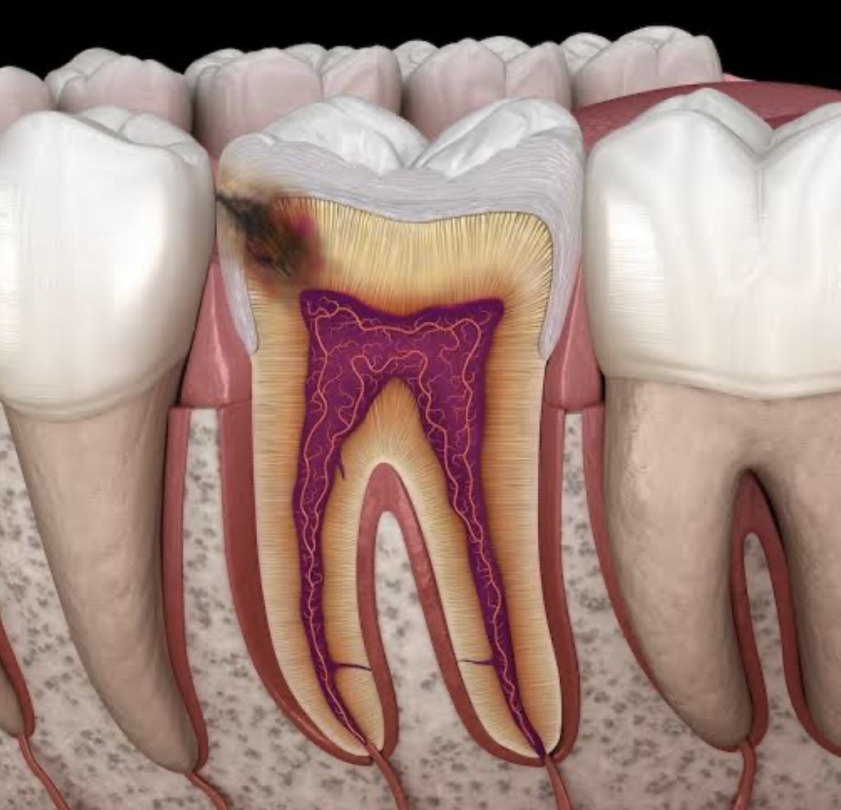 advance tooth decay advance tooth decay
