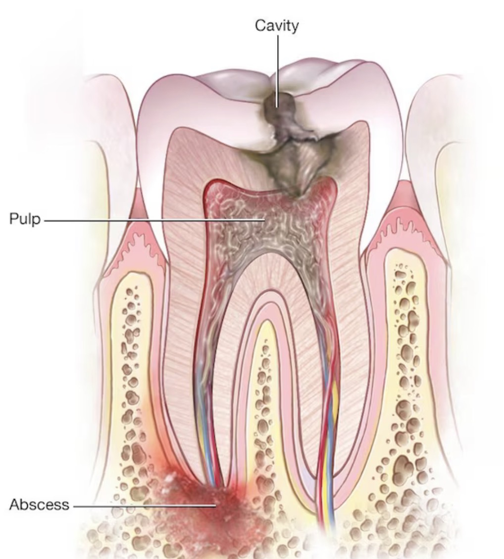 dental abscess in dubai dental abscess