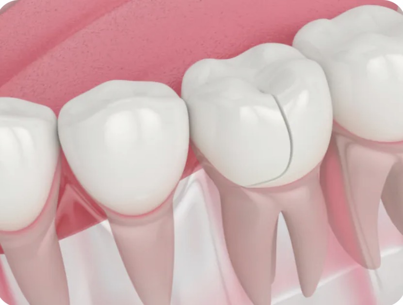 cracked tooth cracked tooth