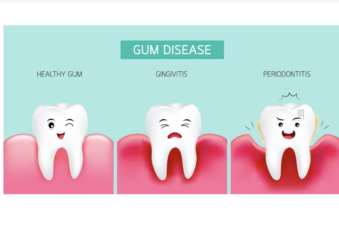 gum disease gum disease