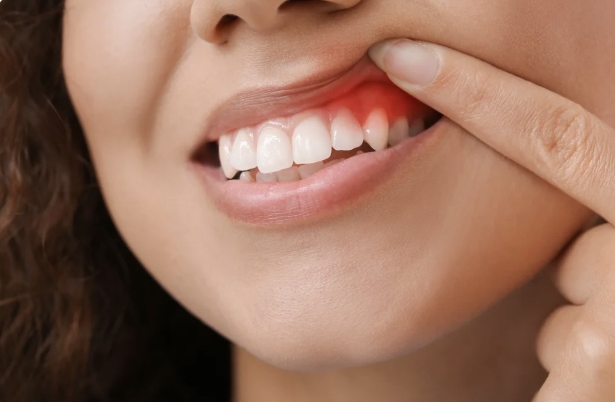 gum treatment