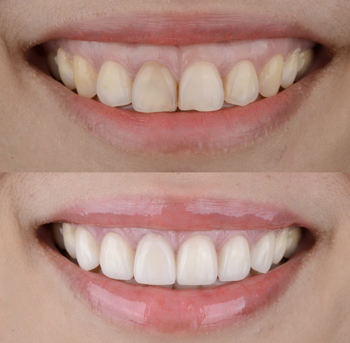 crown lengthening