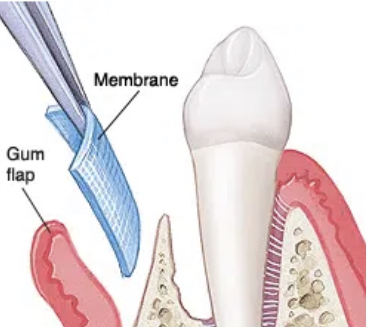 GTR periodontal