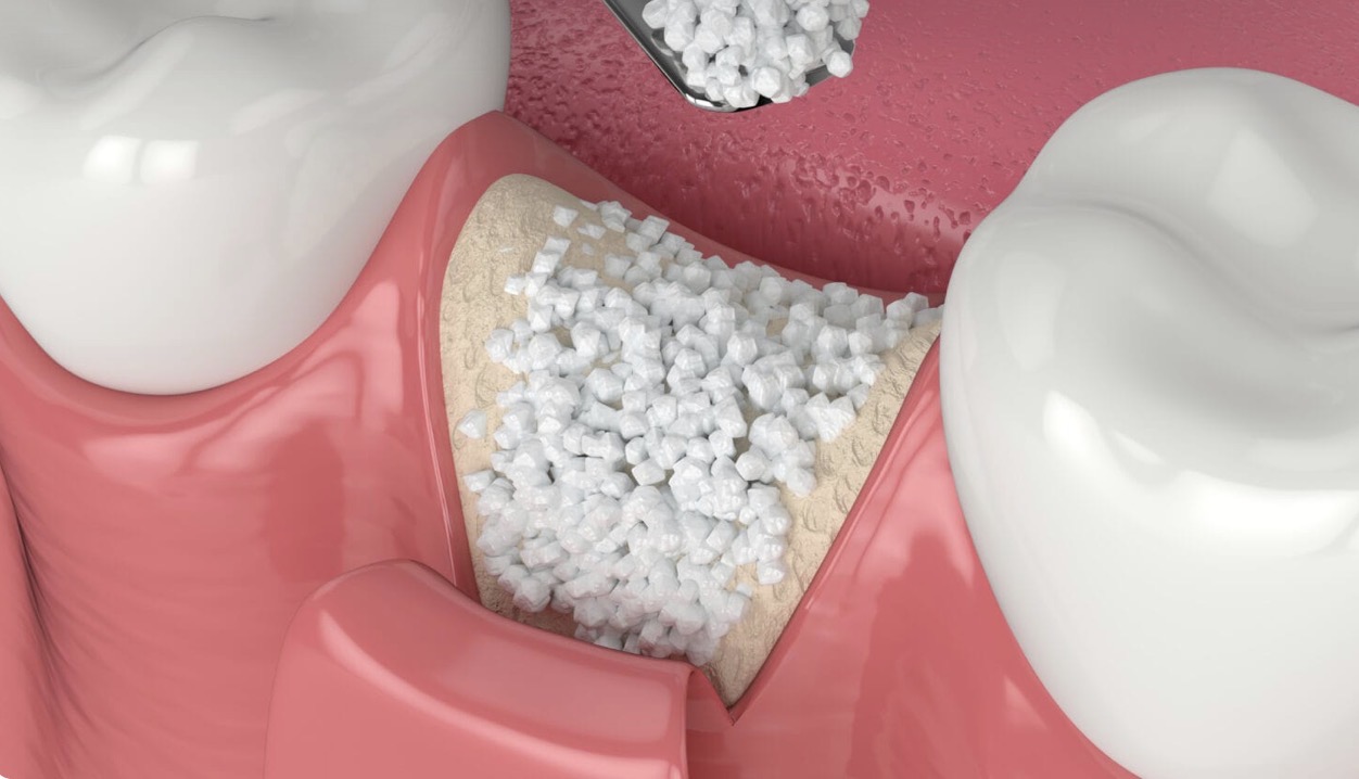 bone graft