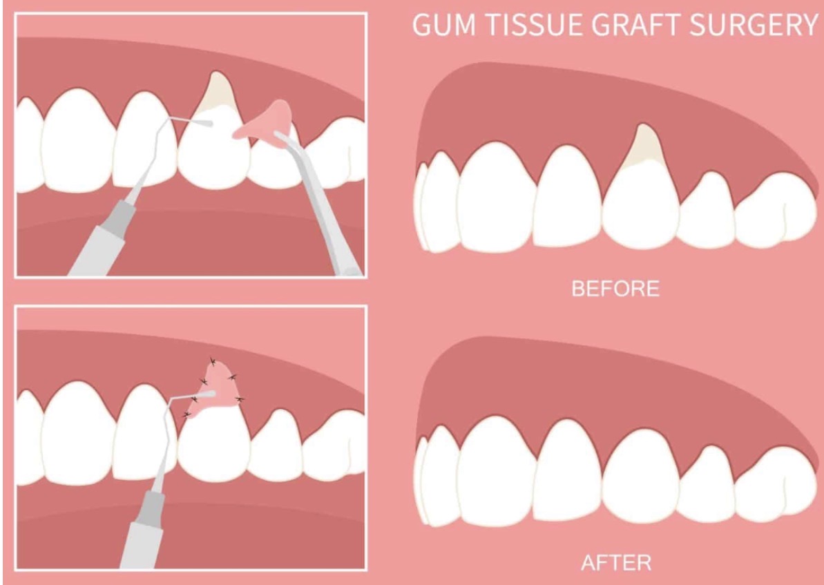 Gum Graft Surgery