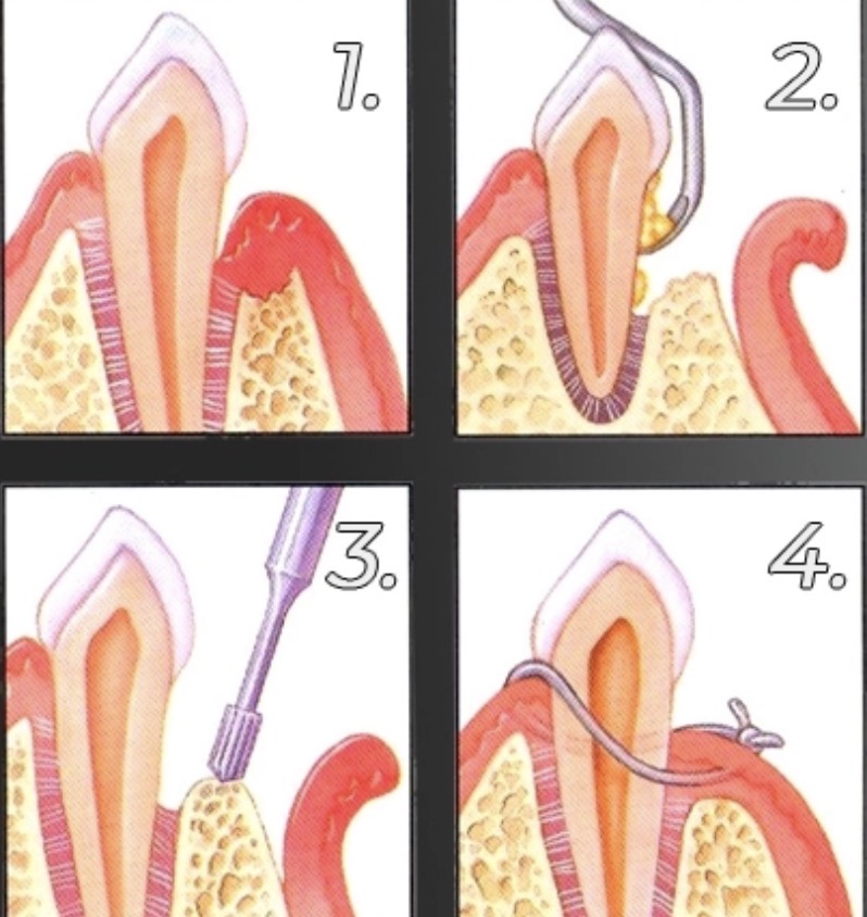 Flap Surgery (Pocket Reduction Surgery)