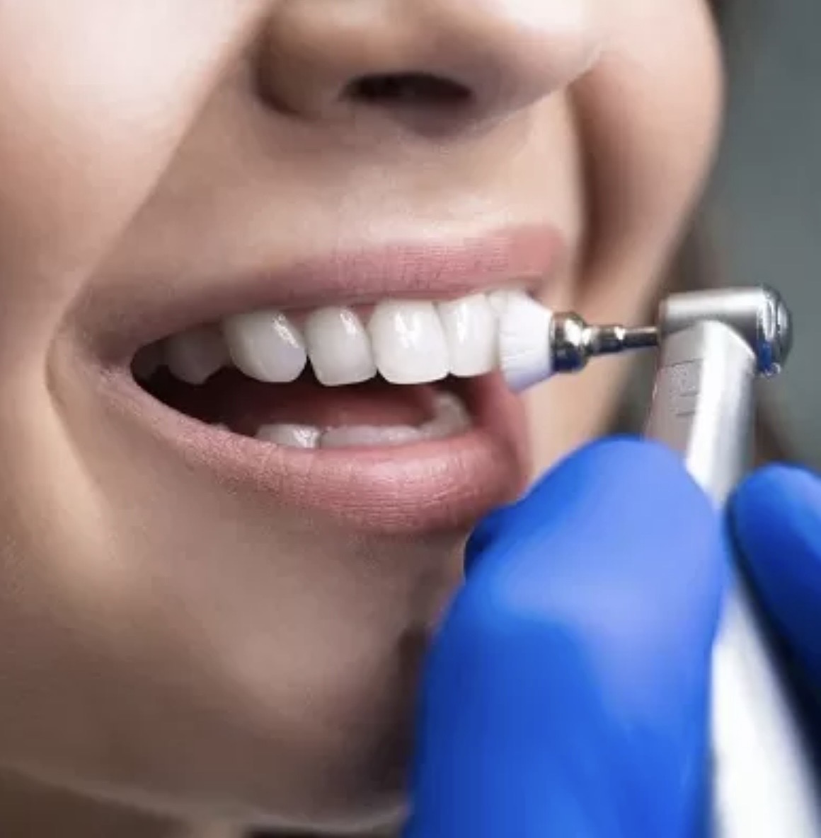teeth cleaning