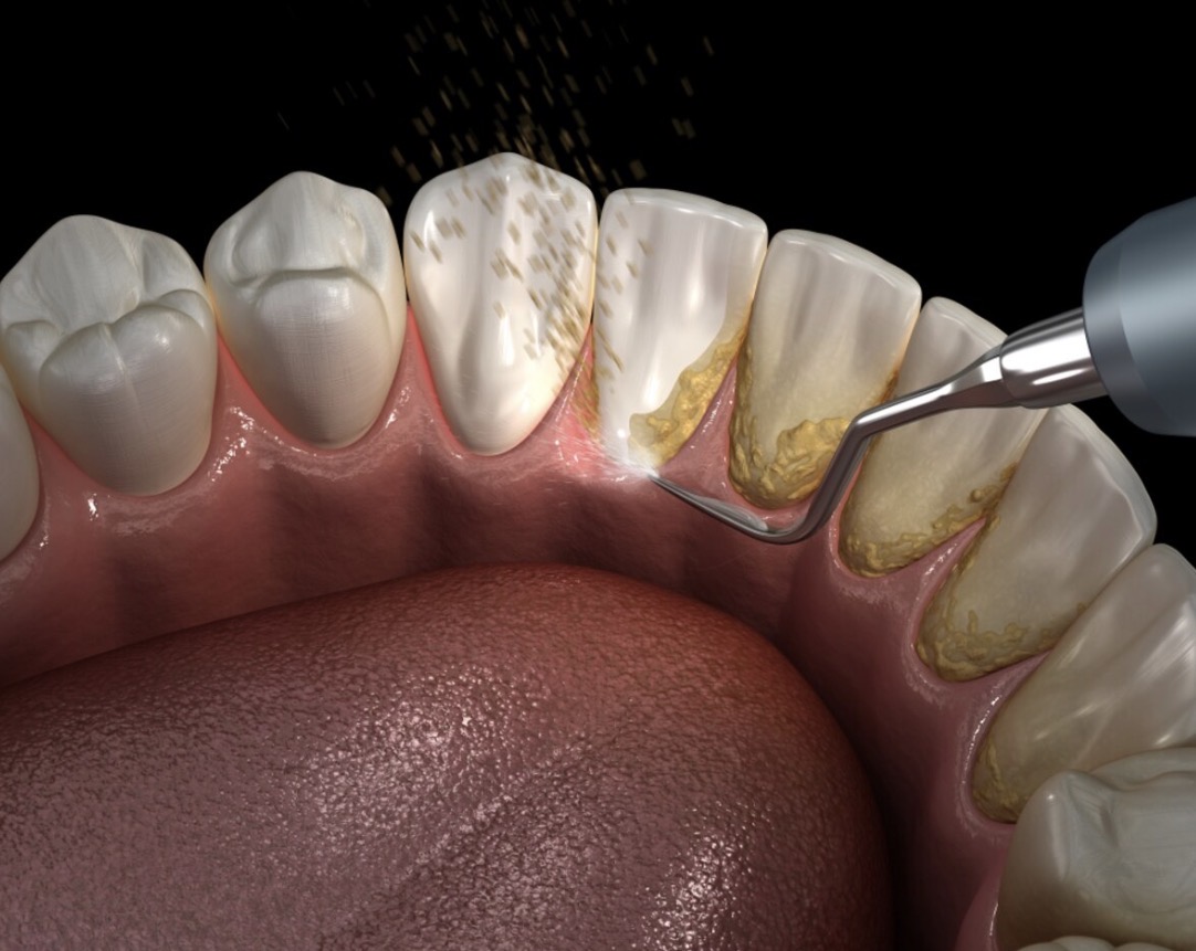 teeth cleaning teeth cleaning