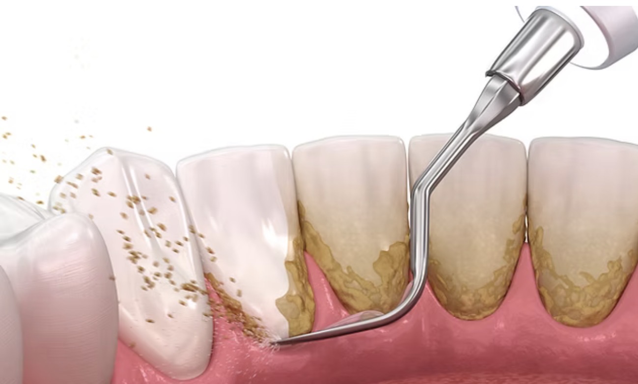 teeth cleaning teeth cleaning