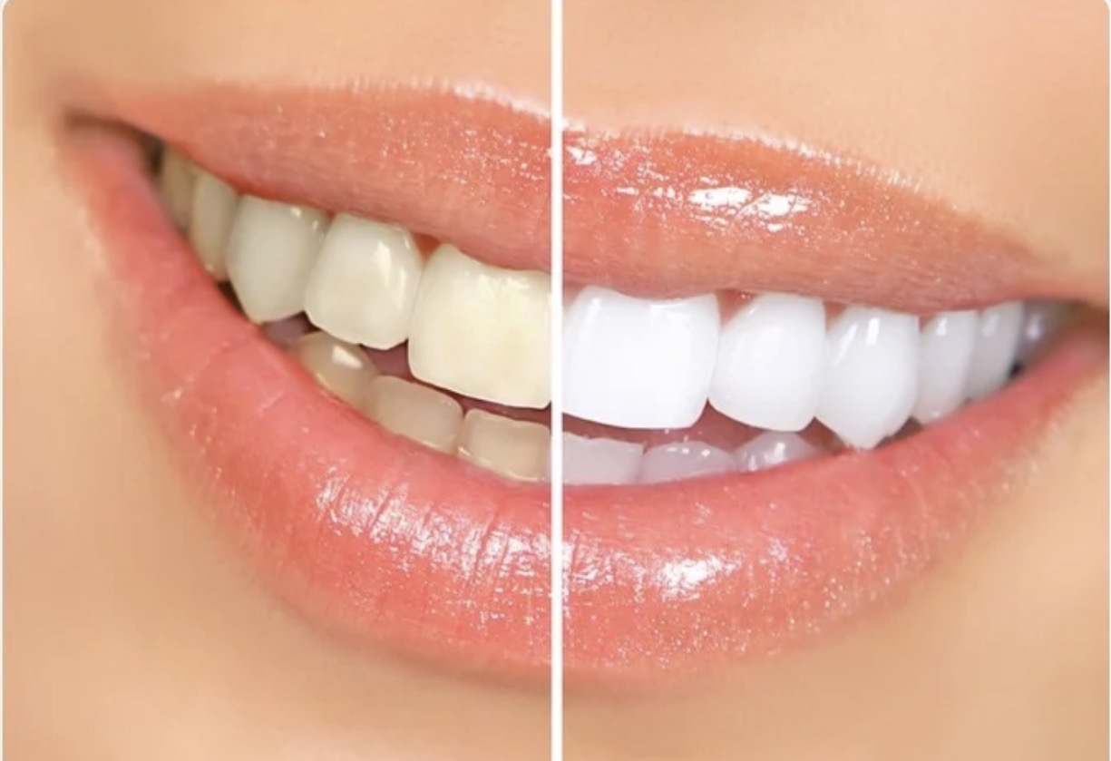 teeth whitening in dubai teeth whitening