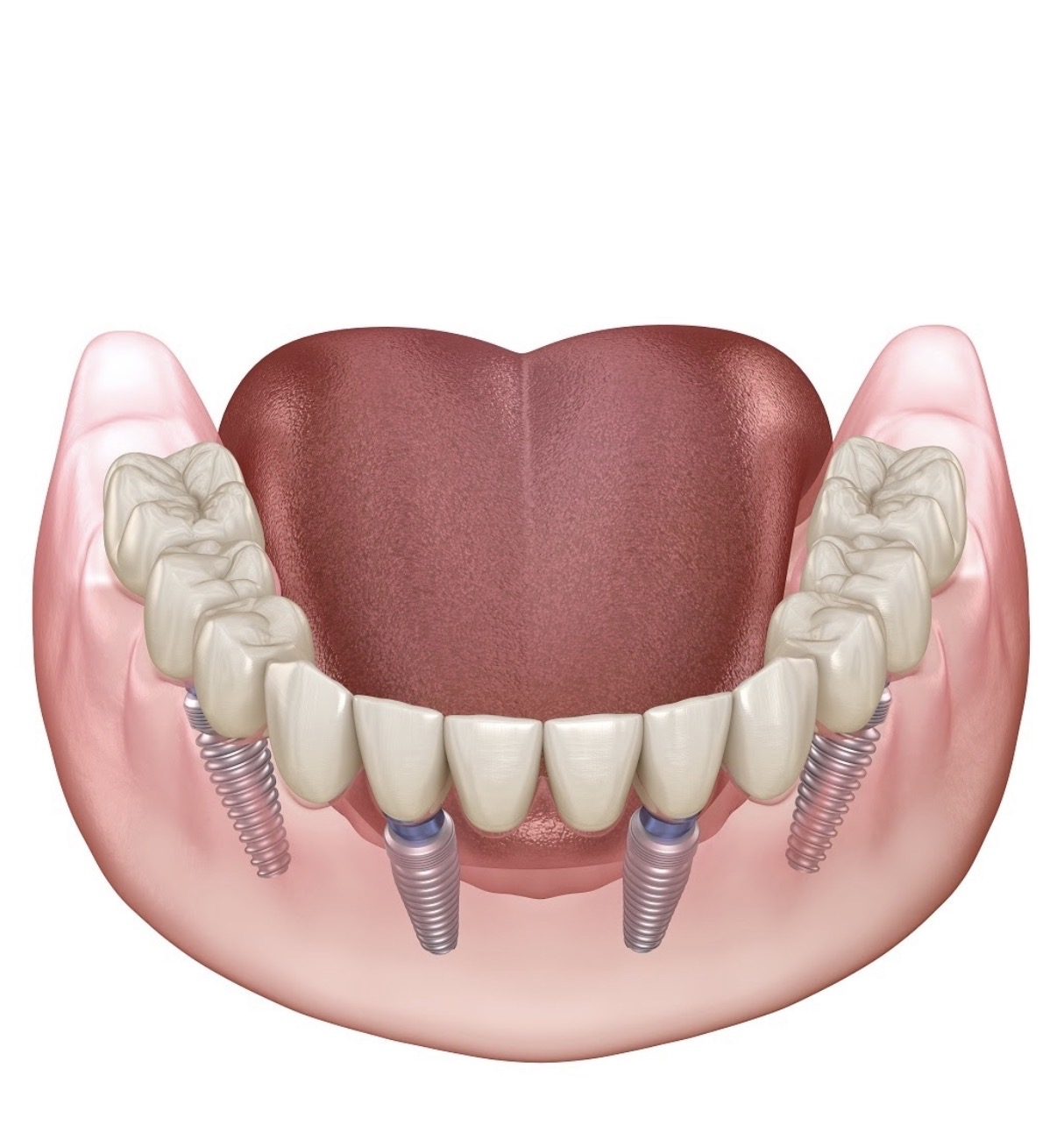 full mouth rehabilitation