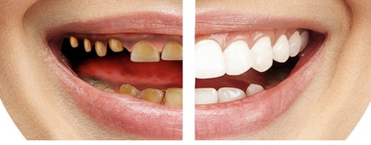 Tooth-Supported Rehabilitation