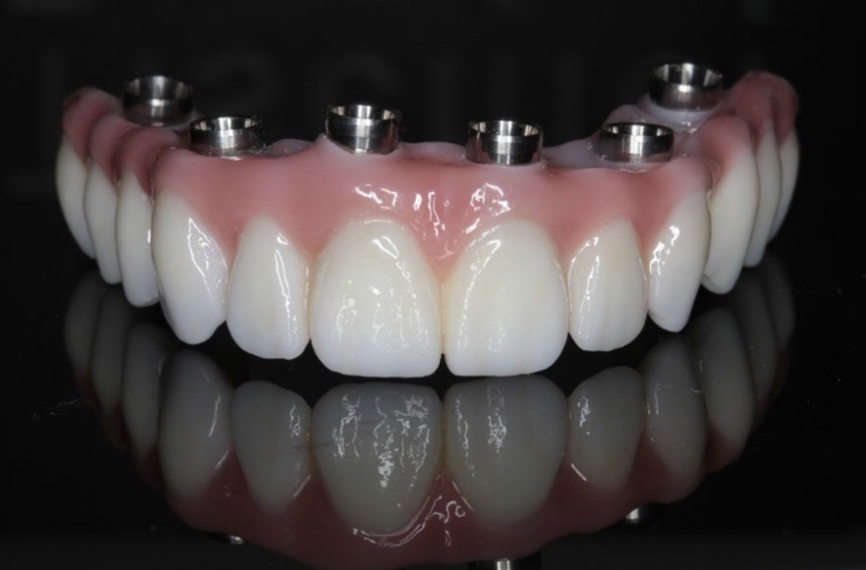 full mouth implant