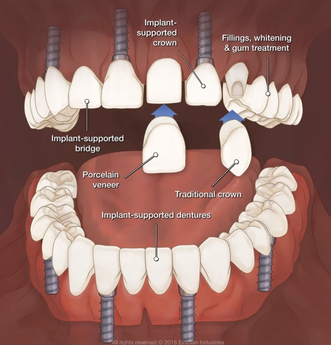 Combination (Hybrid) Full Mouth Rehabilitation
