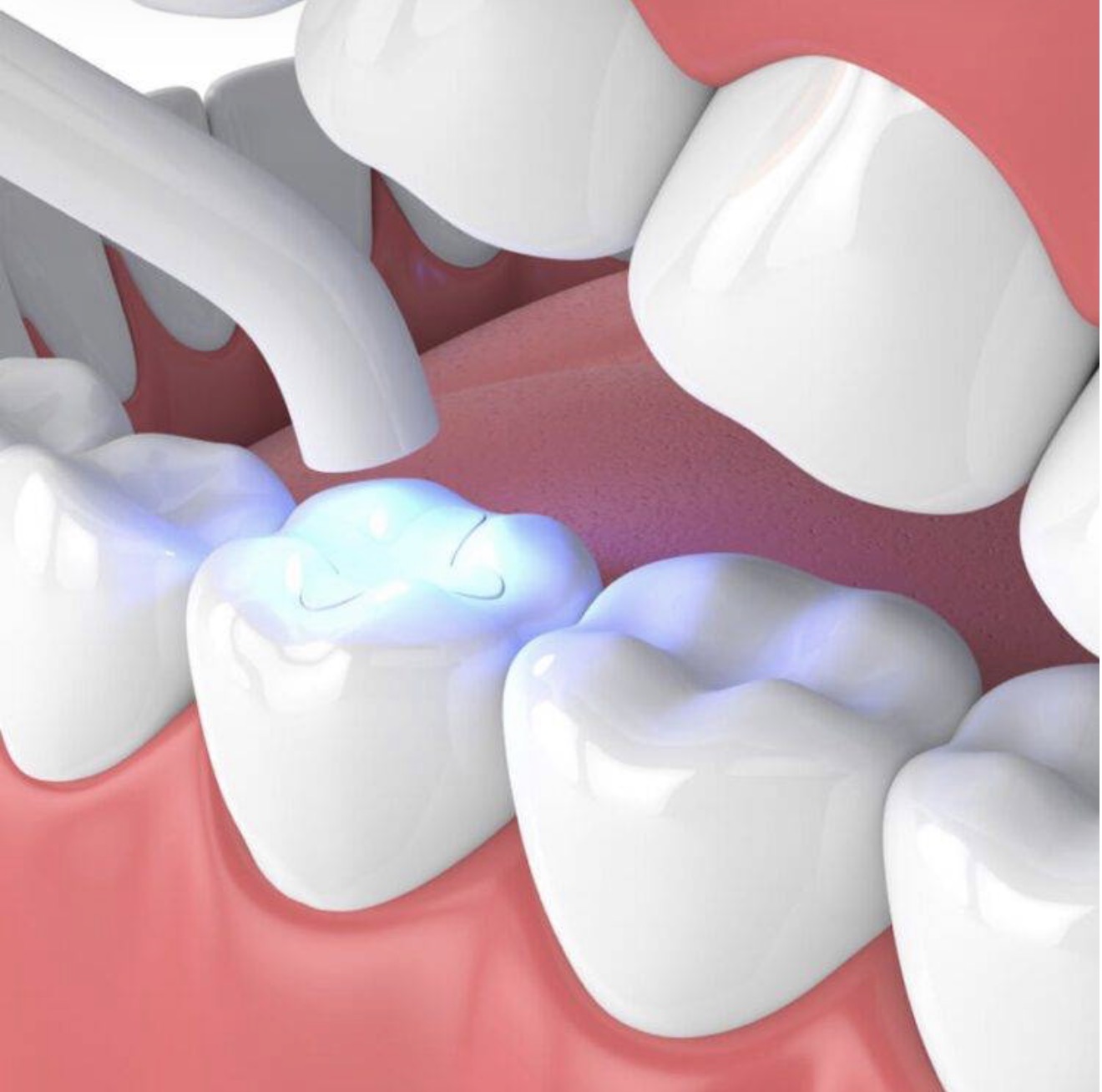 tooth filling