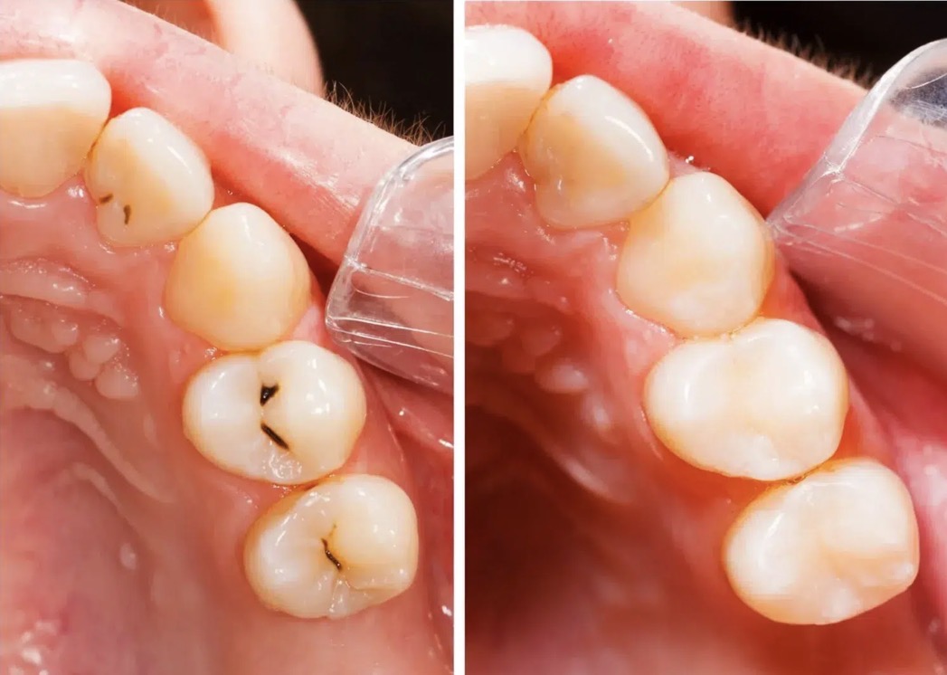 camposite filling