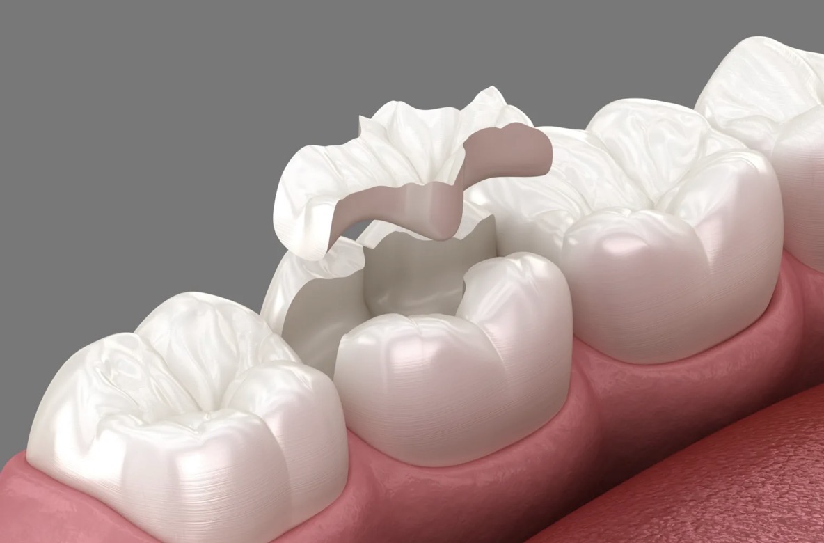 porcelain filling