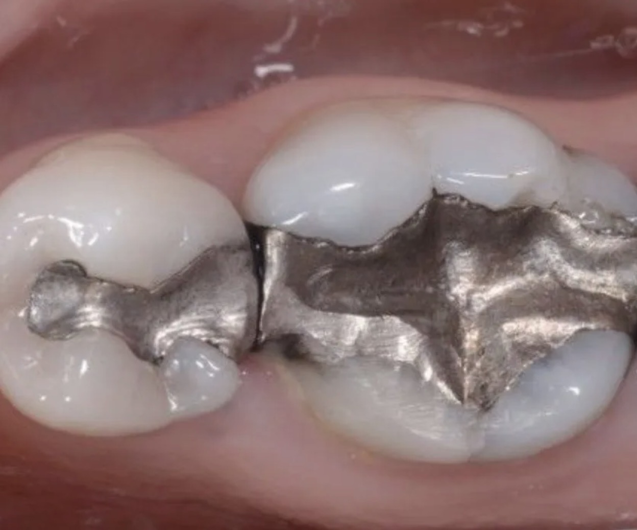 amalgam filling