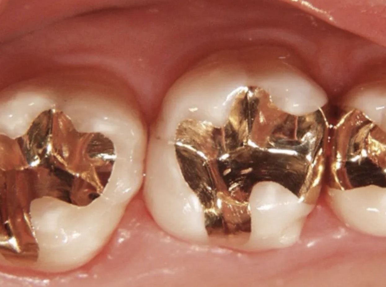 gold filling