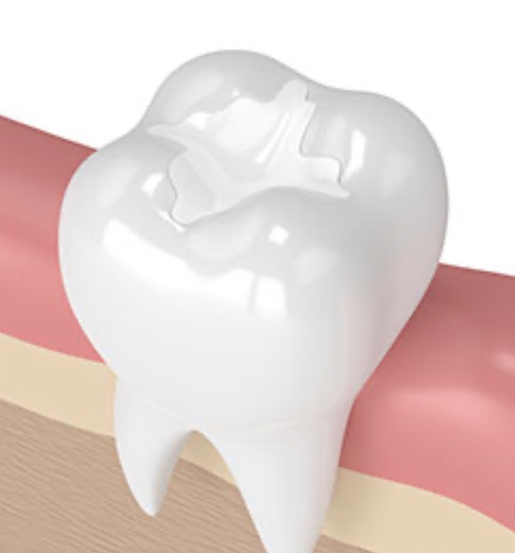 Tooth-Colored Fillings