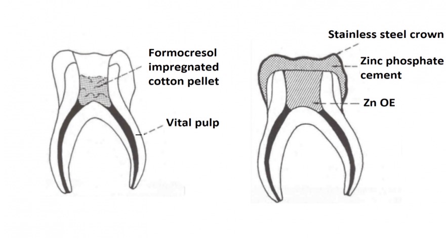 Pediatric Pulp Therapy (Baby Root Canal)