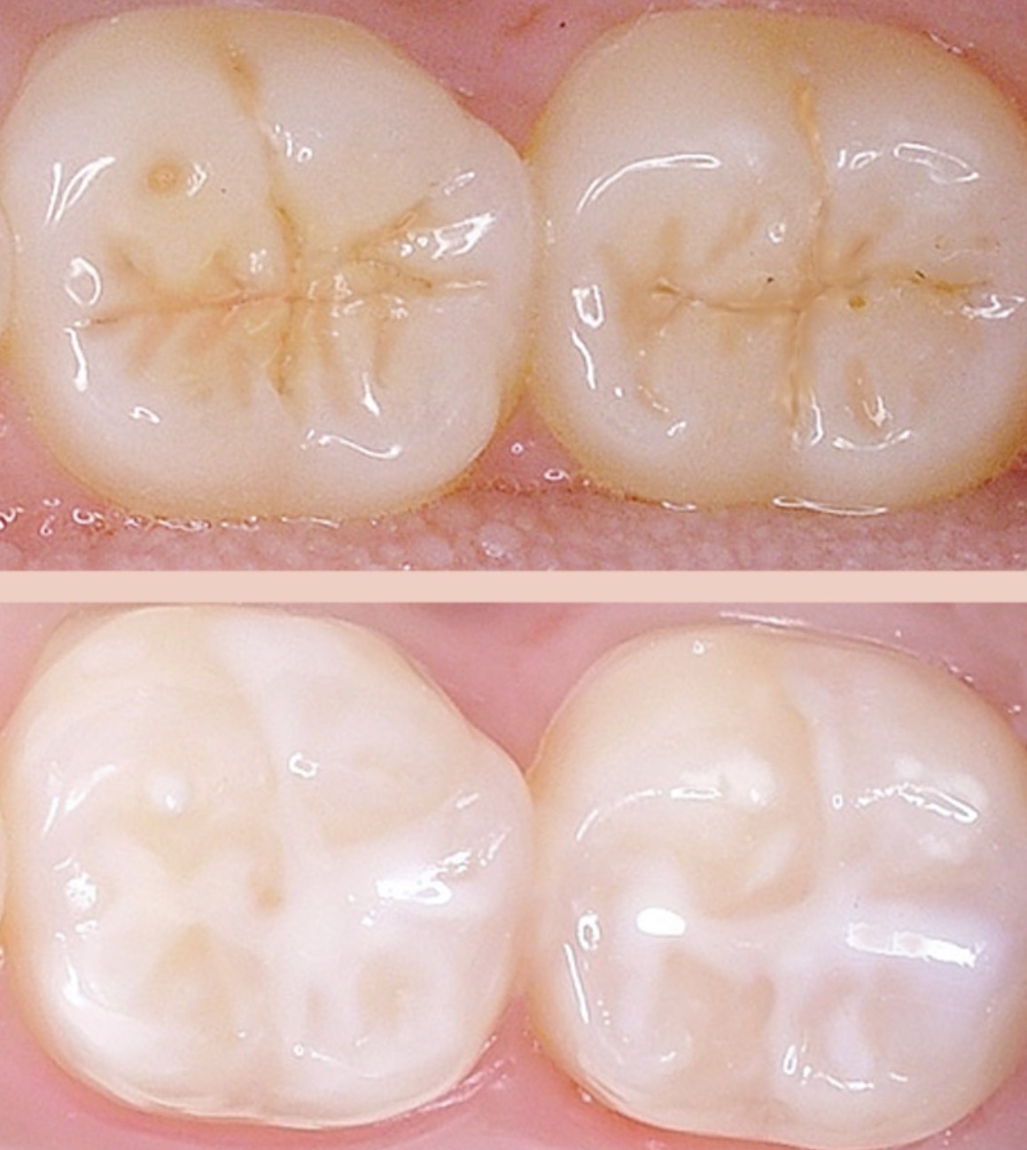 Dental Sealants