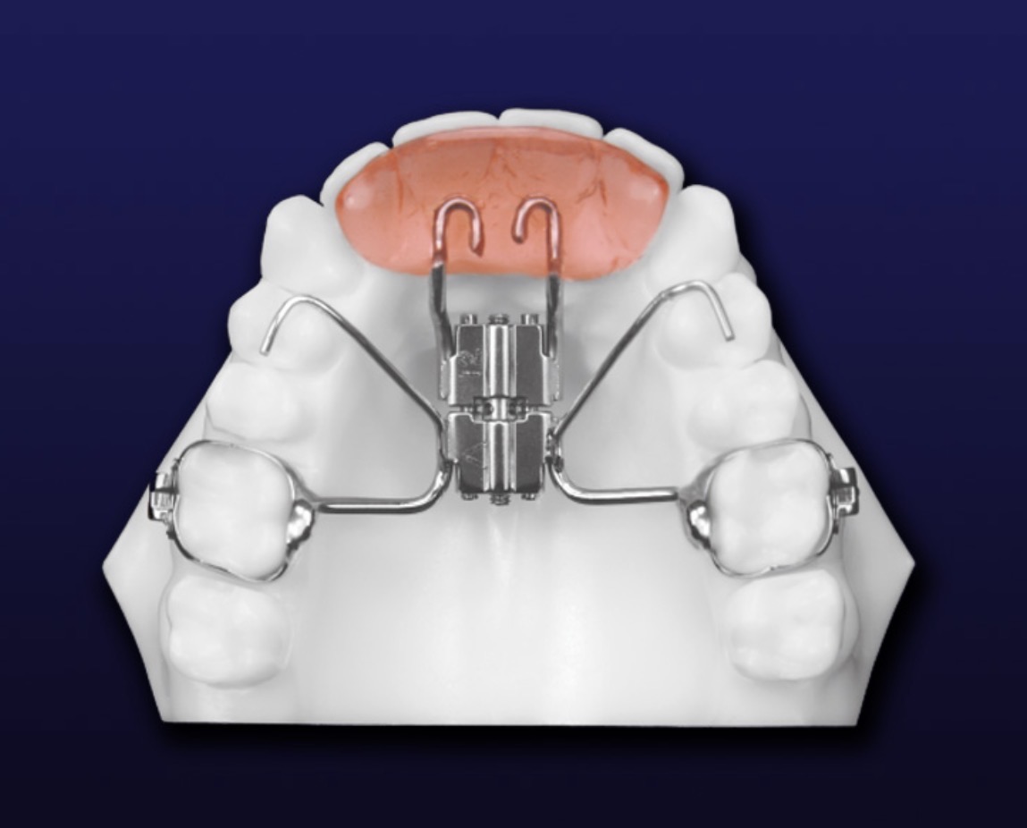 Orthodontic treatment