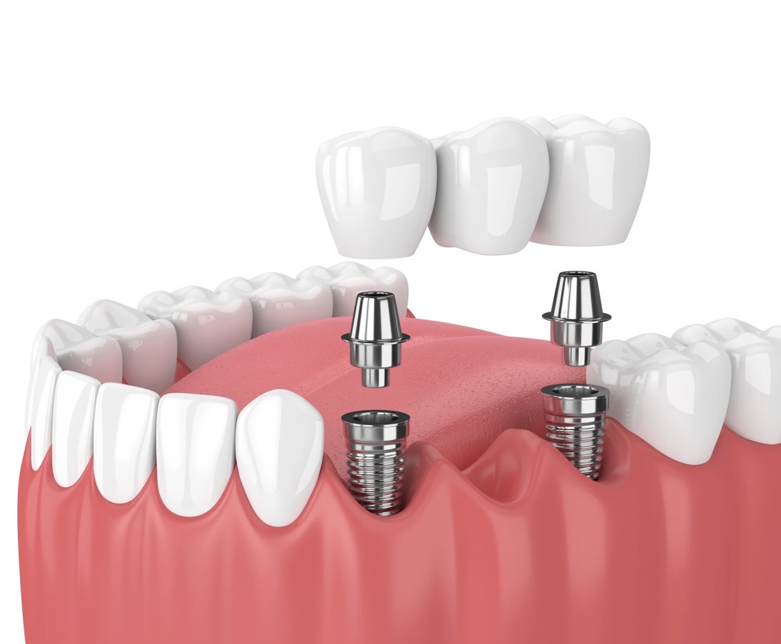 Implant-Supported Dental Bridge